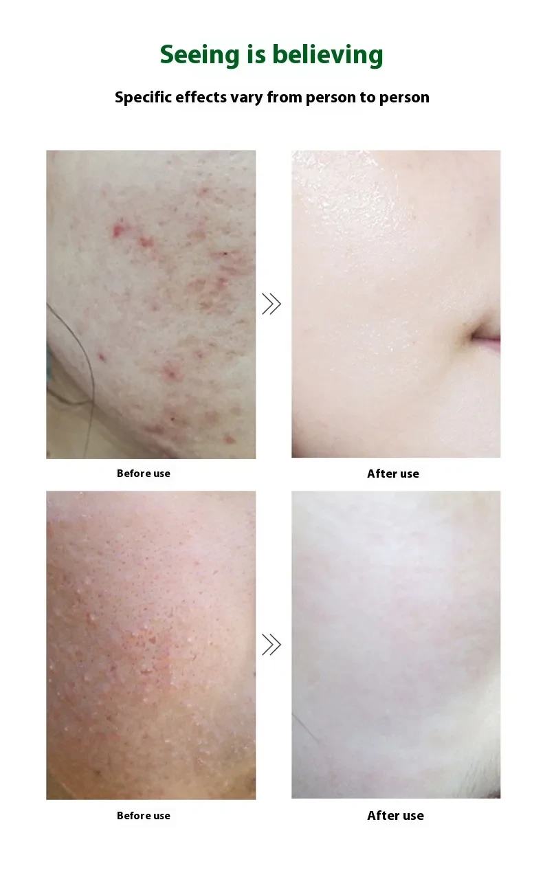 Skin Clearing And Acne Removing Beauty Salon Freeze-dried Power