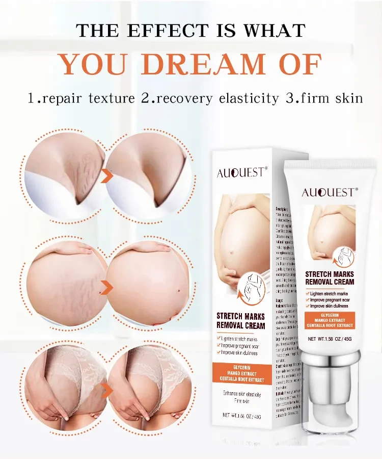 Acne Cream Stretch Mark Treatment Maternity Repair