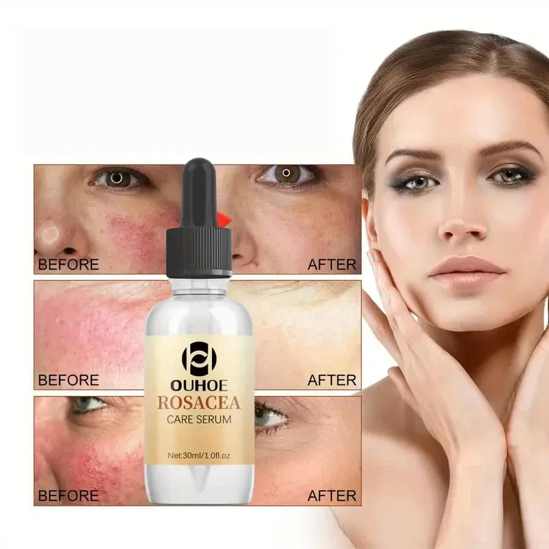 OUHOE Rosacea Care Serum, 60pcs, Facial Skincare, Essential Oils, Moisturizes & Nourishes, Reduces Skin Redness, Soothes & Eliminates Scaly Skin, Suitable for All Skin Types, with Glycerin, Tea Tree, Aloe Vera, and Urea