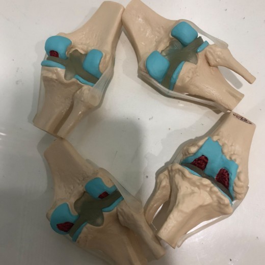 Four-Stage Diseased Knee Joint Model Sick Joint Model