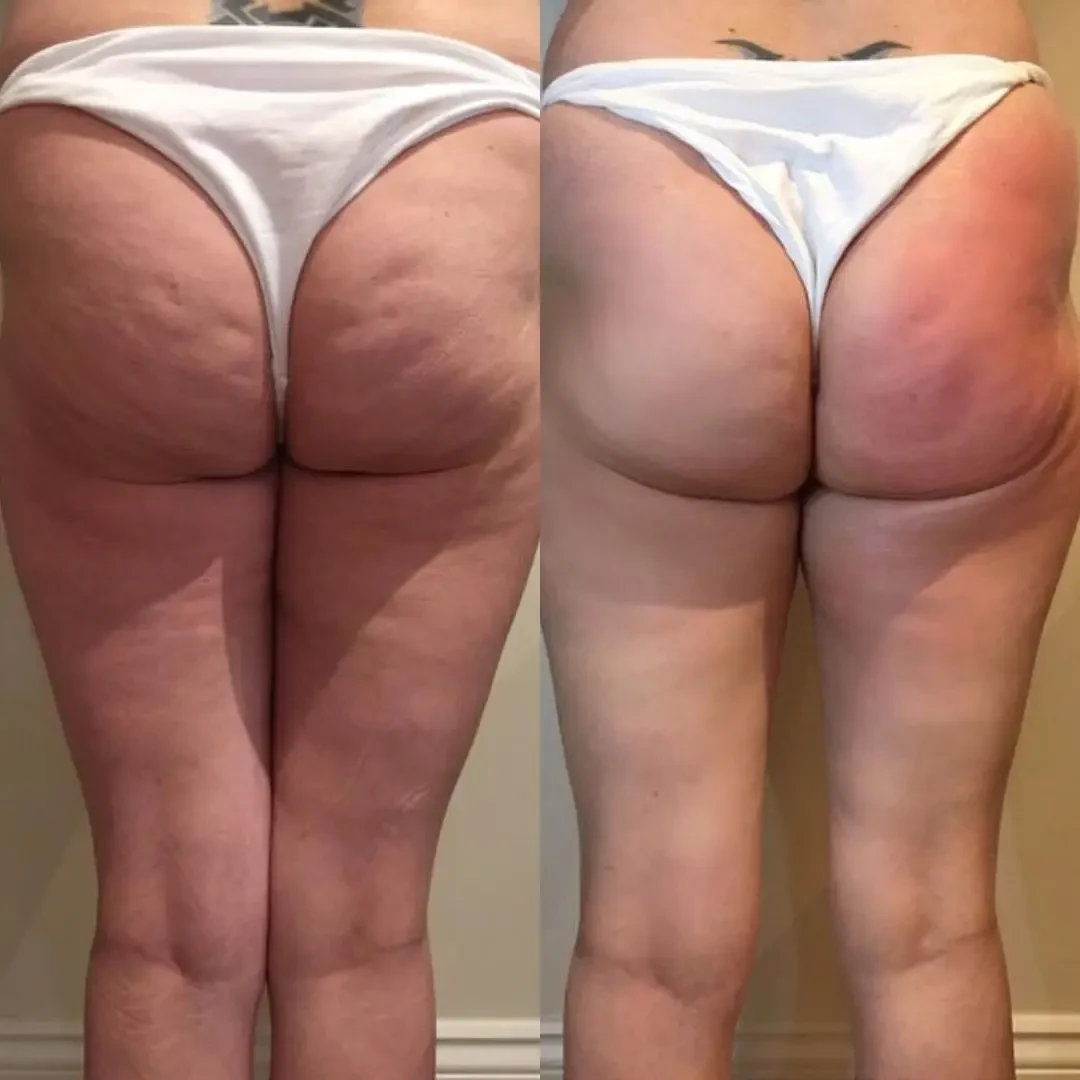 Sonicfit Ultrasonic Cavitation