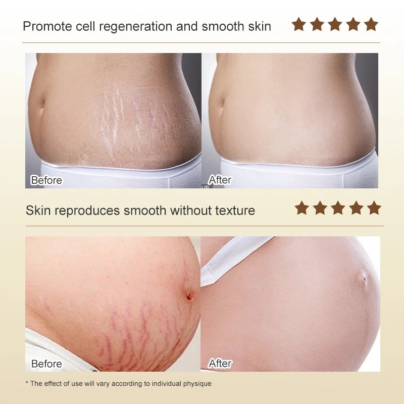 Stretch Marks Permanent Removal Cream - Skin Repair and Firming Care