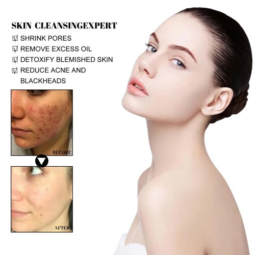 Blackhead Cleaning Mud Film Reduces Acne Marks And Blackheads