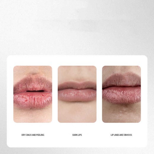 Fade Lip Lines Moisturize And Prevent Dry Cracks
