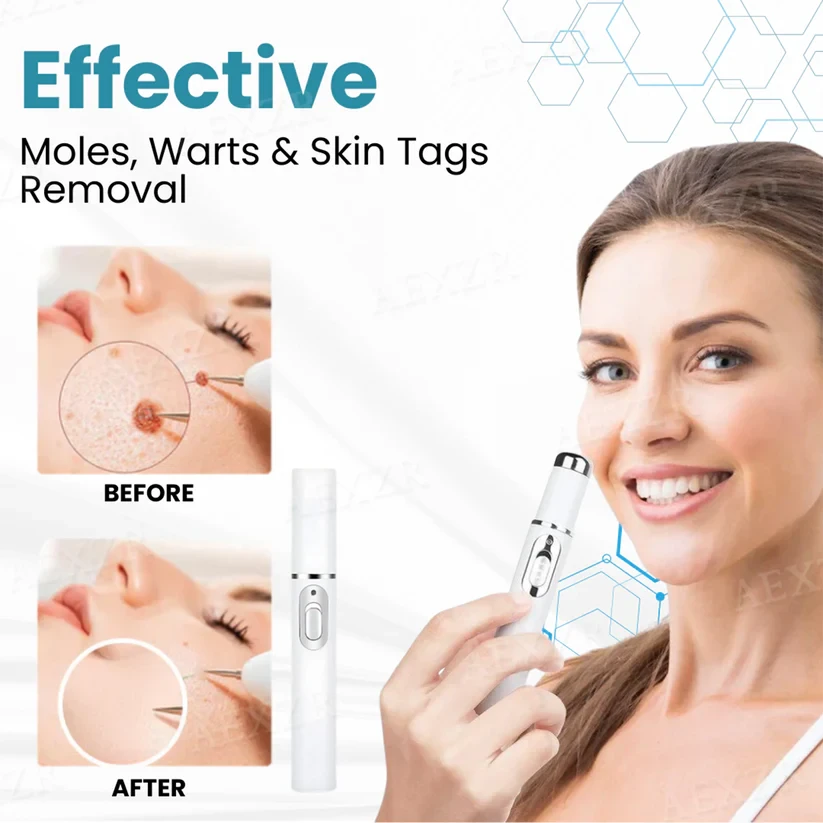 Bikenda Non-Invasive Mole and Wart Removal Laser Pen